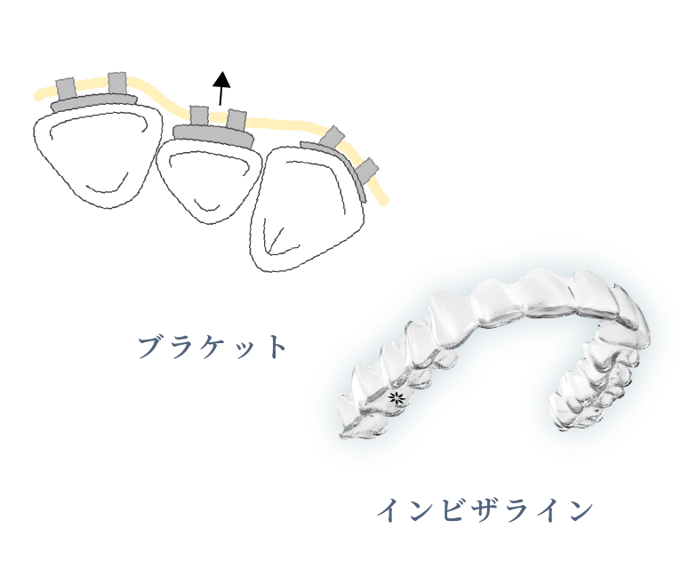 ブラケット、インビザライン