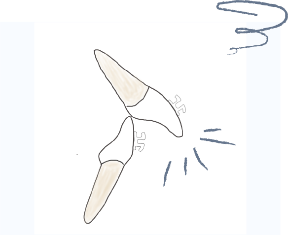 歯が傾いている